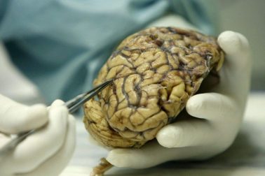 alzheimer5