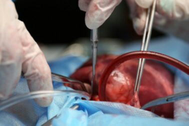 transplantacia