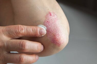 psorioza1