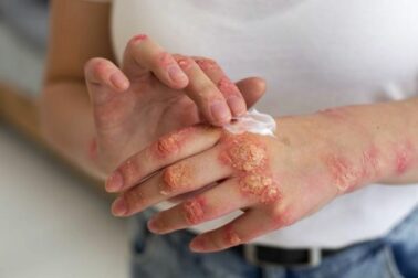 psorioza2
