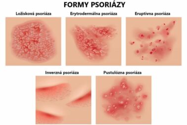 psorioza3