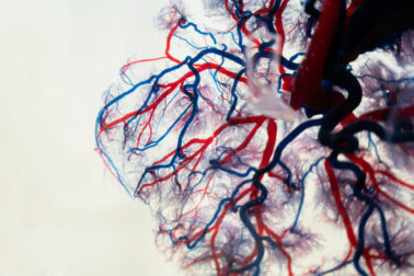 akutny koronarny syndrom3