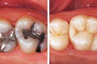 amalgánová plomba a kompozit