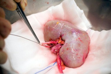 transplantacia3