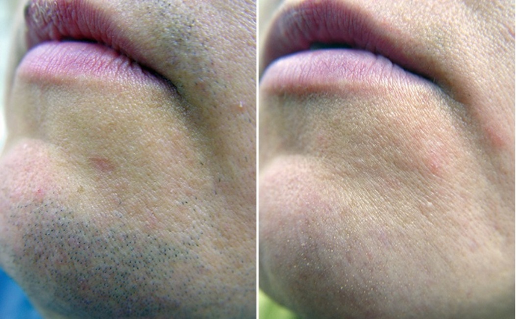 Шугаринг губа. Лазерная эпиляция лица для женщин. Электроэпиляция волос на лице.