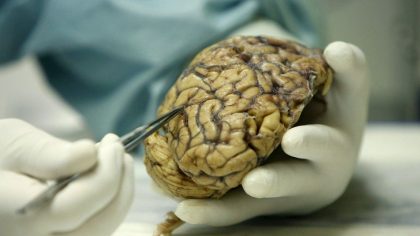 alzheimer5