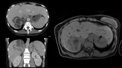CT - MR Echinokok
